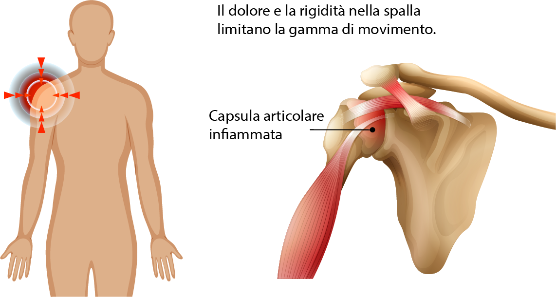 Artrosi della spalla - capsula articolare infiammata