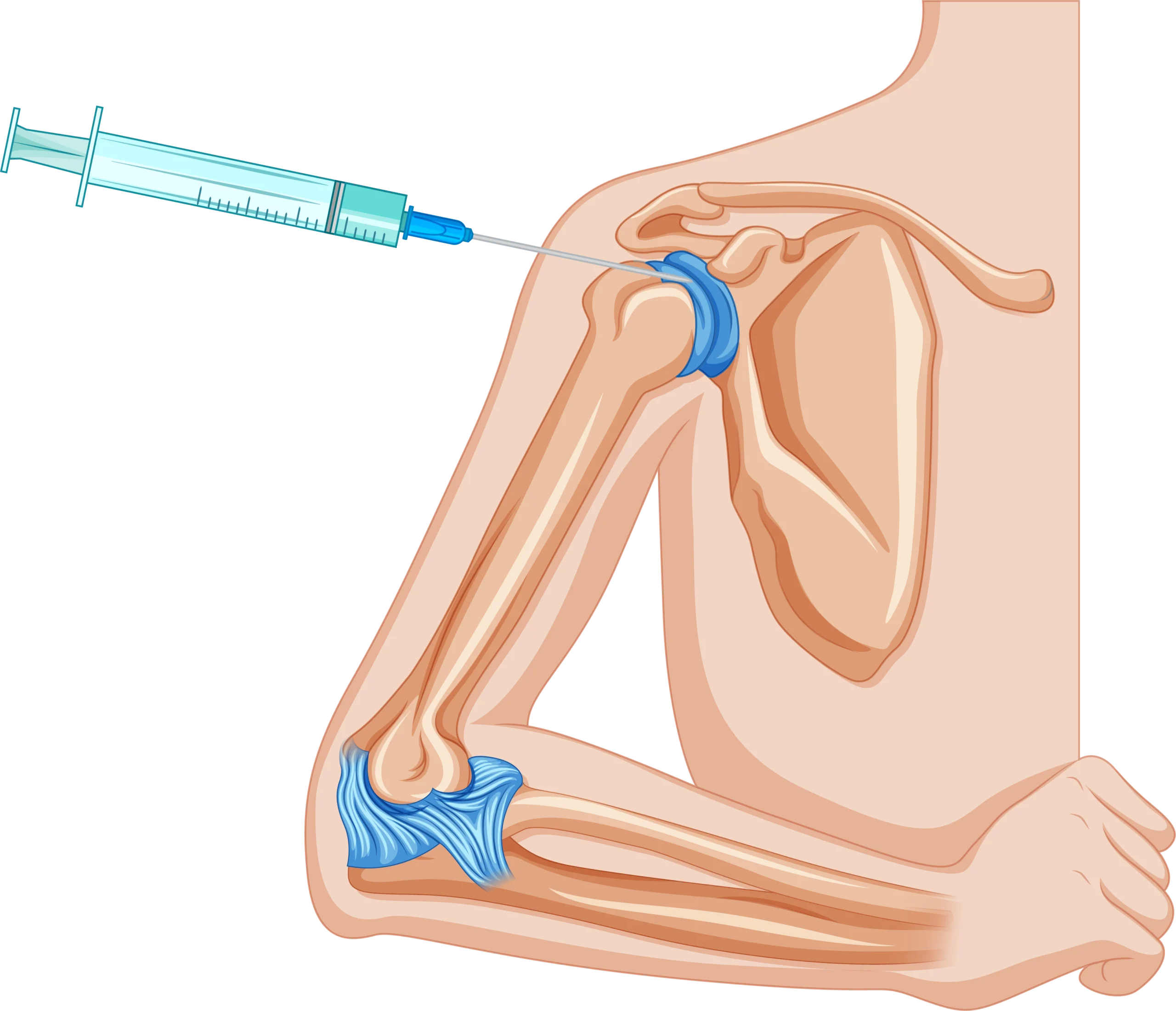 Infiltrazioni ecoguidate