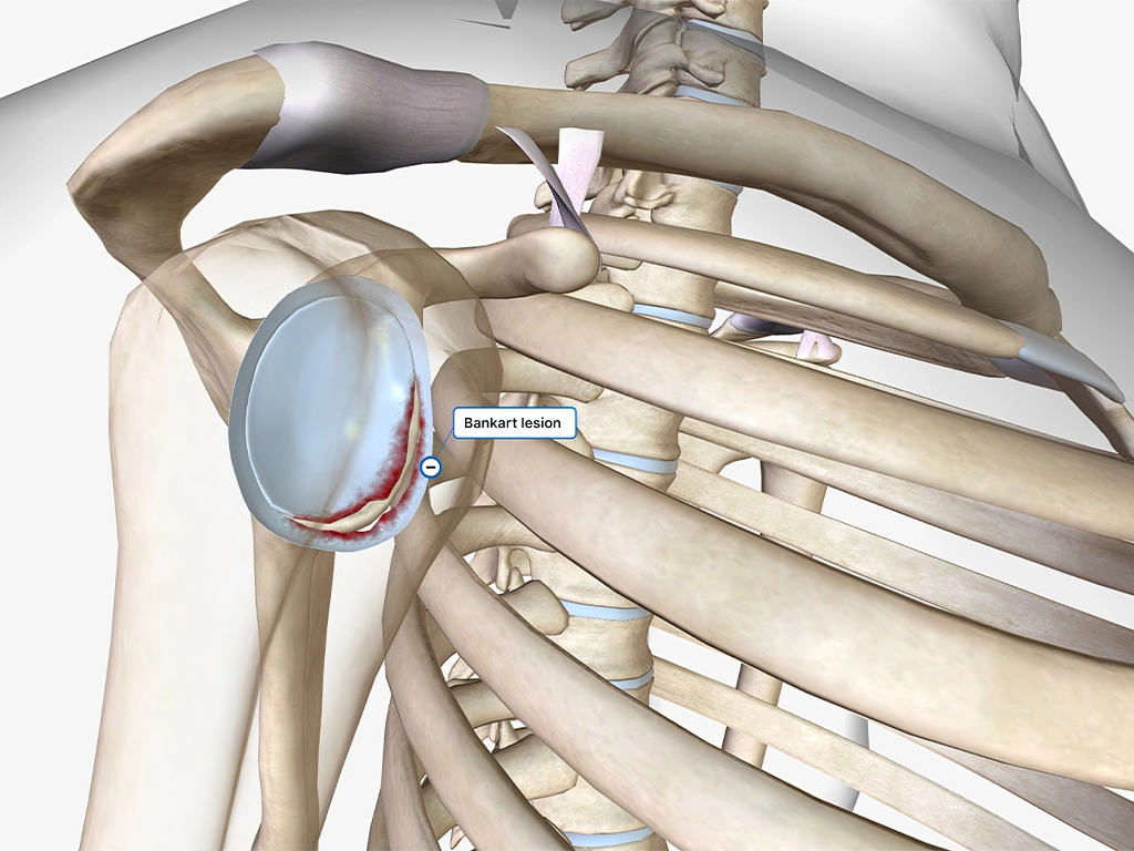 Instabilità della spalla
